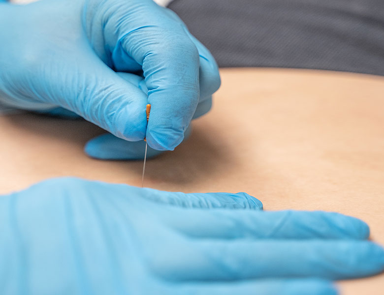 Dry Needling